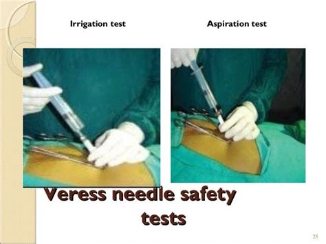 Method for safe Verres needle entry at the umbilicus, with 